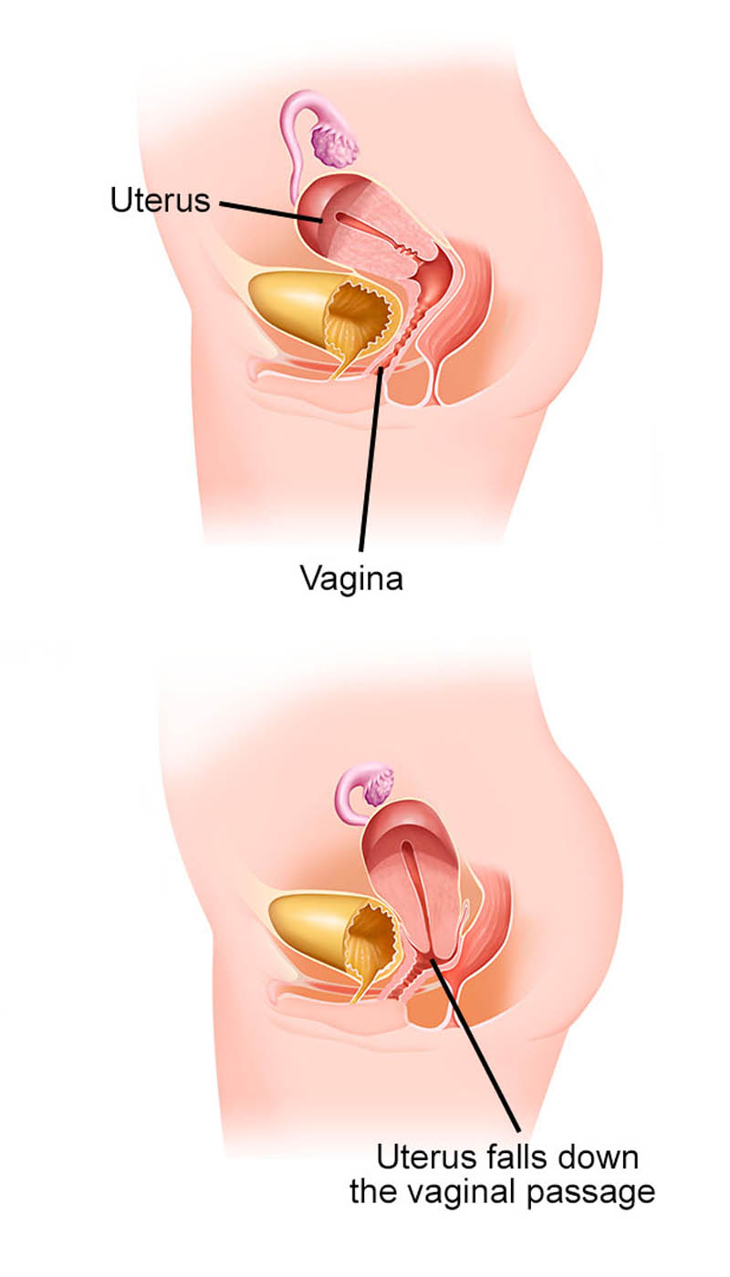 Prolapsed vagina