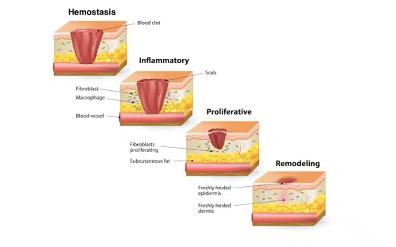 The stages of tissue healing